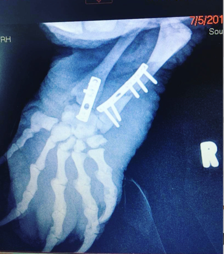 X-ray showing a hand with connector on its broken part.